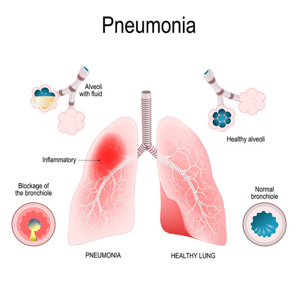 pneumonie